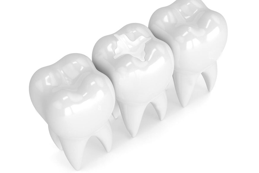 Konya Beyaz Diş Dolgu, Konya Kompozit Diş Dolgusu, Konya Beyaz Diş Dolgusu Fiyatları, Konya Kompozit Diş Dolgusu Fiyatları 2022 için Konya Özel Diş Hekimi Mine Değer'den randevu alın.